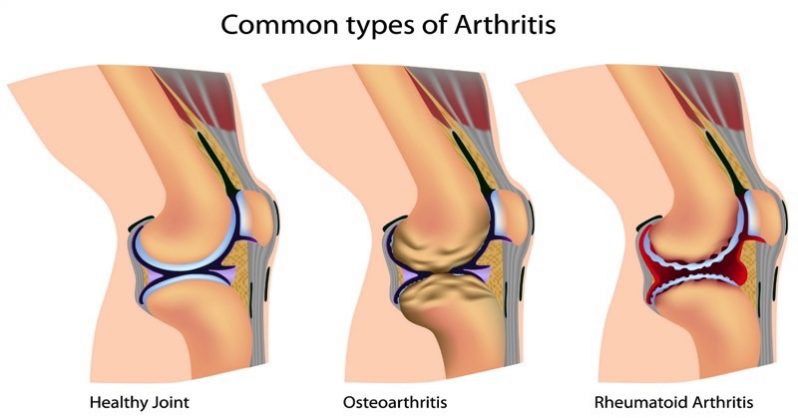 How an Anti-Inflammatory Diet Could Help With Arthritis Flair-Ups