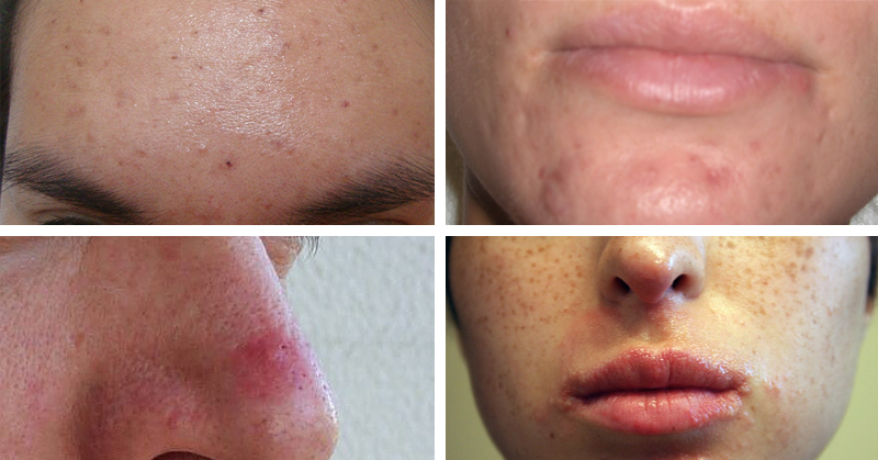 how to get rid of acne