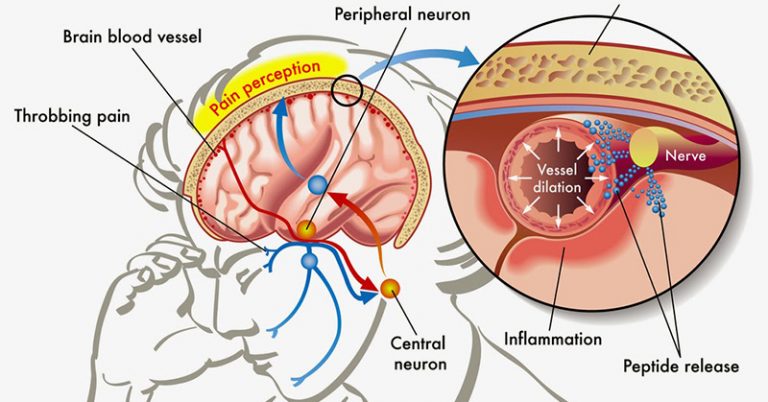 The Link Between Your Serotonin and Headaches and Migraines - Featured image