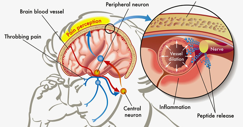 The Link Between Your Serotonin and Headaches and Migraines