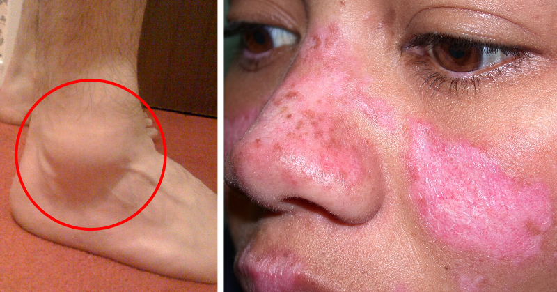 Lupus Symptoms: 13 Ways to Spot Lupus Disease Early
