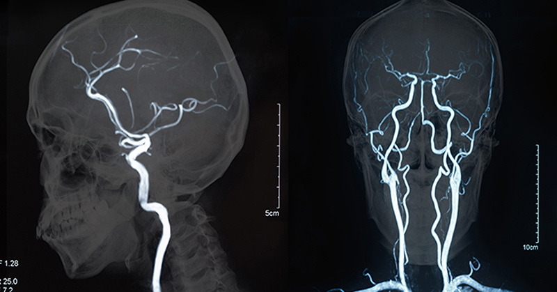 7 Deadly and Often Unnoticed Signs of a Stroke
