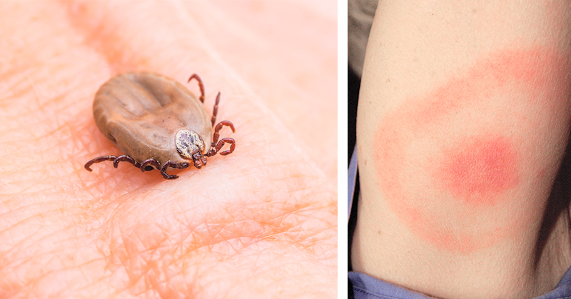 5 Ways to Make Sure You Don’t Get Lyme Disease This Summer