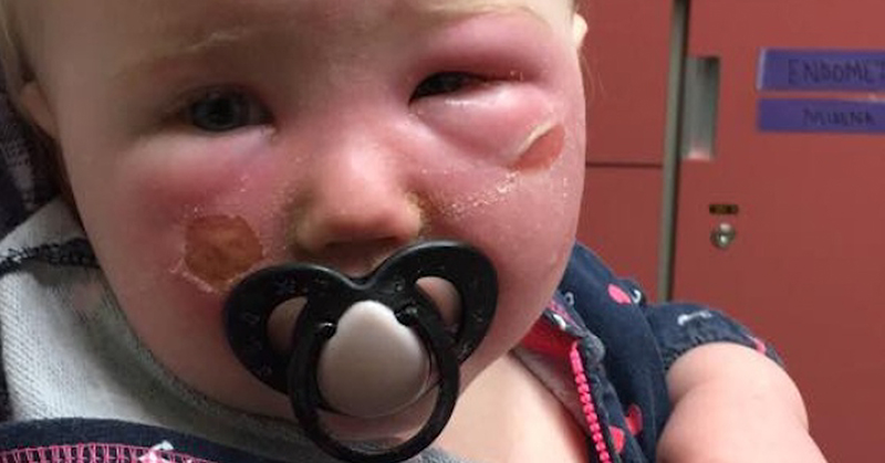 Mom Warns About Sunscreen After 14-Month-Old Daughter Ends Up in ER