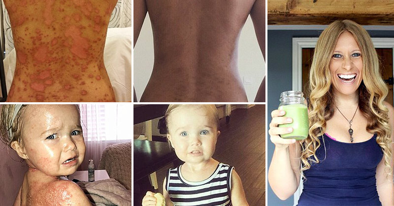 Psoriasis and Eczema Sufferer Created Diet That ‘Cured Her’ and  is Helping Thousands of Sufferers