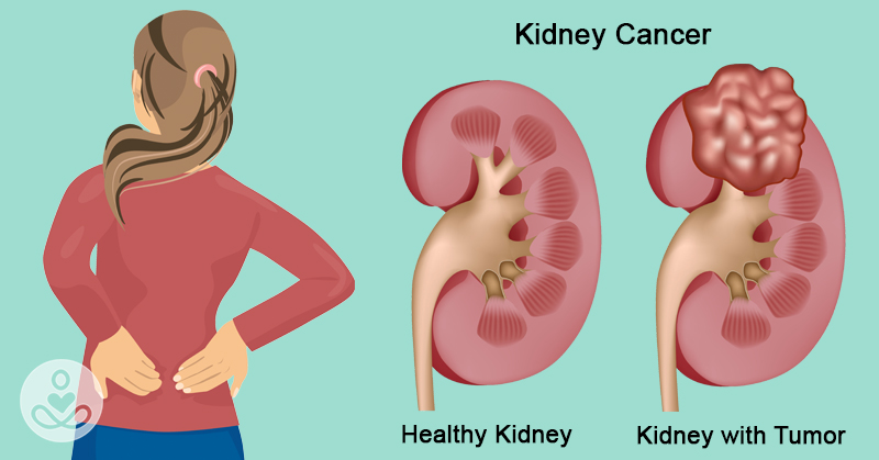 7 early warning signs that cancer is growing inside your kidneys