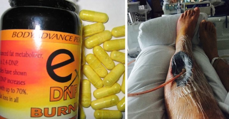 25 year old dad takes diet pills to lose weight – ends up almost losing one of his legs instead - Featured image