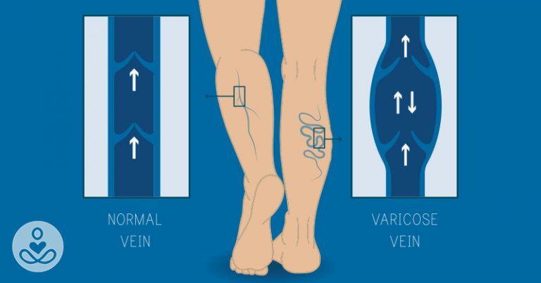 3 science-backed tips you should know to get rid of varicose veins on your legs - Featured image