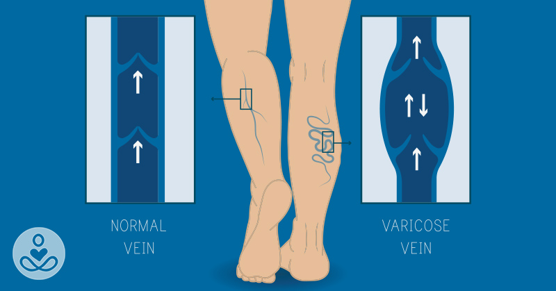 3 science-backed tips you should know to get rid of varicose veins on your legs