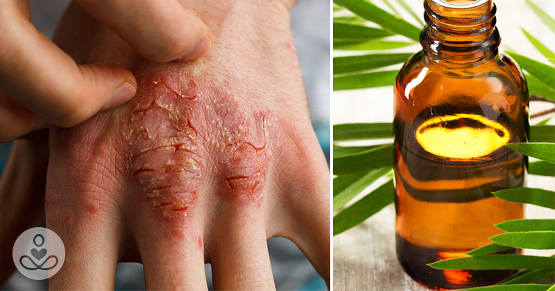 Tea tree oil is far more useful than you think. Here are 10 reasons why you need it at home - Featured image