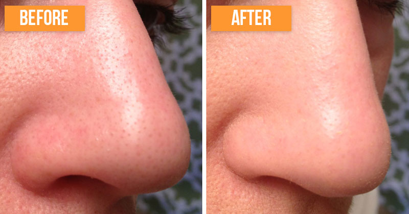How to Get Rid of Blackheads Naturally (2-Ingredient Recipe)