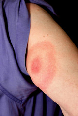 lyme disease symptoms