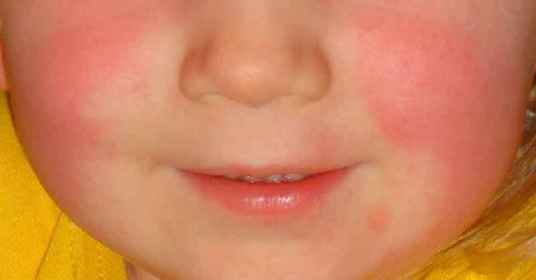Scarlet Fever Signs, Symptoms, And Treatment - Featured image