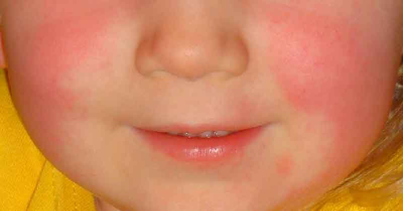 Scarlet Fever Signs, Symptoms, And Treatment