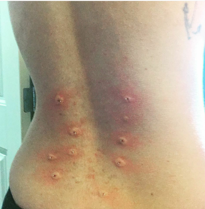 natural treatment for Lyme disease