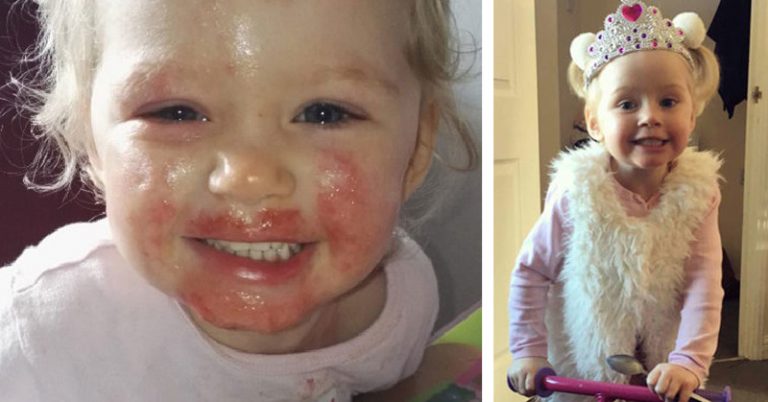 Little Girl’s Story is Proof Why You Should be Cautious of Anyone with Herpes Kissing Your Child - Featured image
