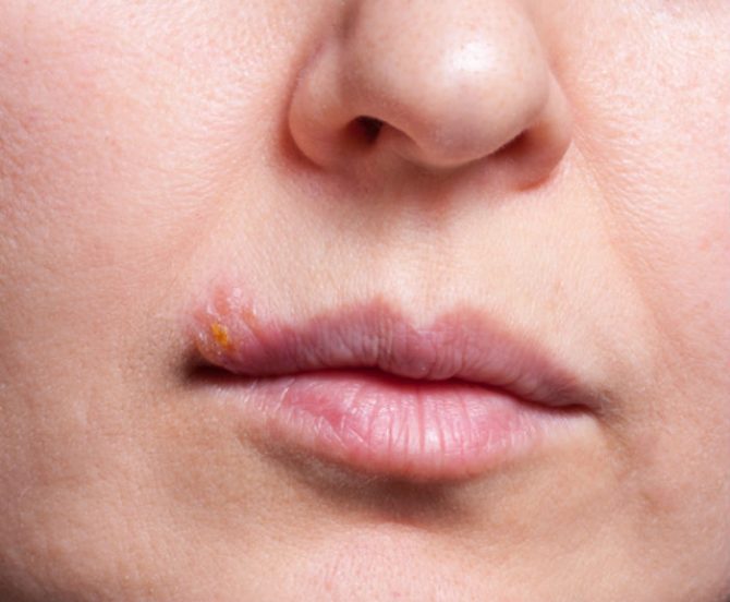 cold sores
