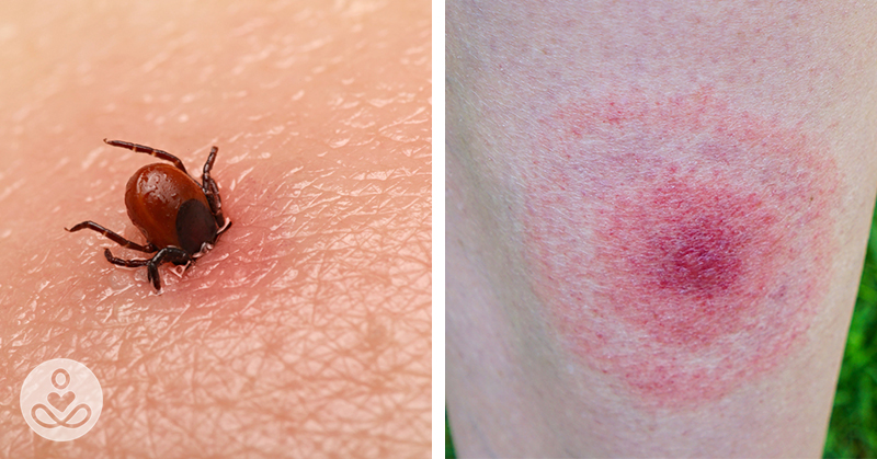 Lyme Disease is On The Rise: Signs, Symptoms, and Treatments