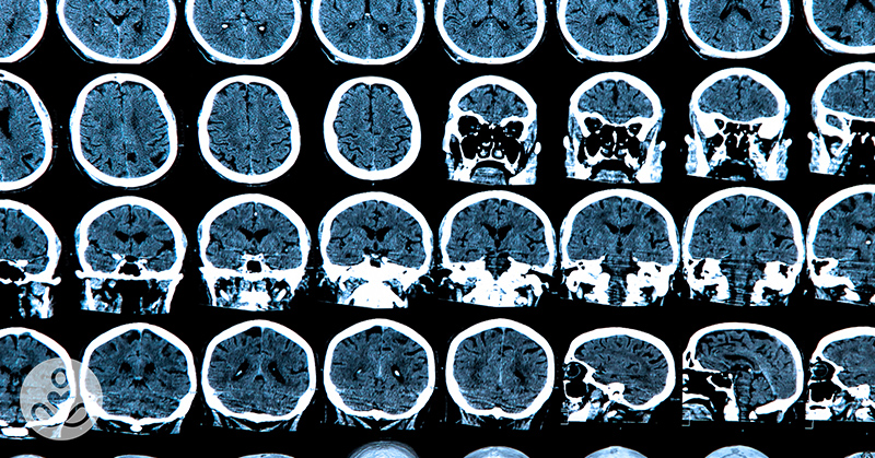 2 Drugs Identified That Could Halt The Progression Of ALL Neurodegenerative Diseases