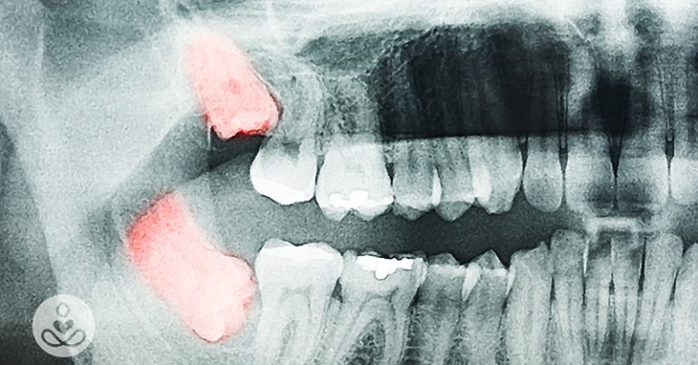 Wisdom Teeth Removal: Is Wisdom Tooth Surgery Really Necessary? - Featured image