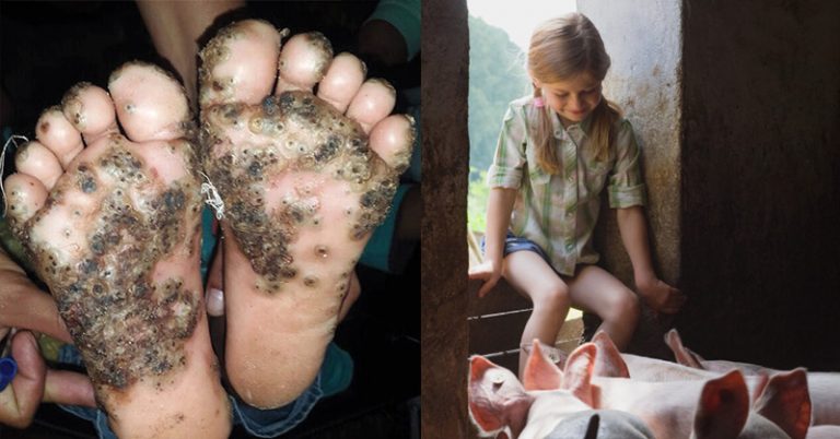 The Sad Story of a Young Girl with Parasitic Sand Flea Infection - Featured image