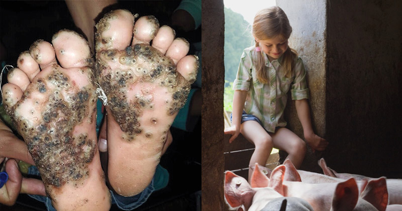 The Sad Story of a Young Girl with Parasitic Sand Flea Infection