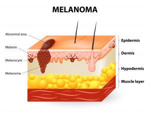 melanoma skin cancer symptoms