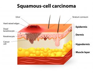 squamous cell carcinoma symptoms