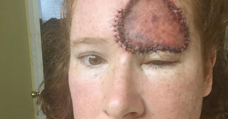 Mom Survives Rare Form of Melanoma, Warns to ‘Stop Frying Your Skin’ - Featured image