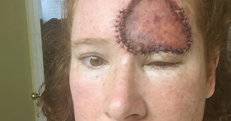 Mom Survives Rare Form of Melanoma, Warns to ‘Stop Frying Your Skin’