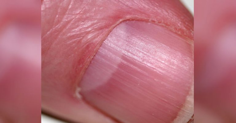 What Is Lunula? Your Lunula, Fingernails, and What They Say About Your Health - Featured image