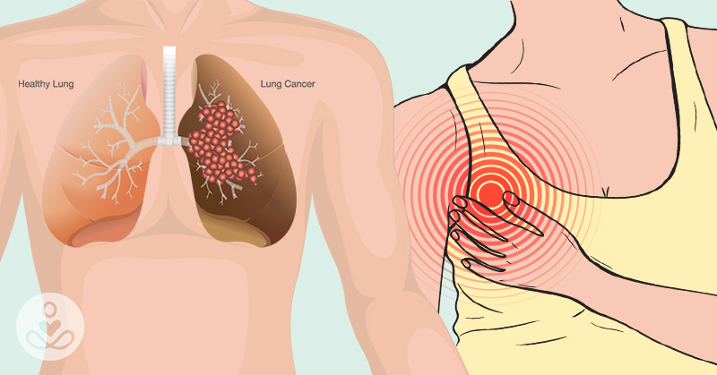 12 Symptoms of Lung Cancer That Everyone Should Know