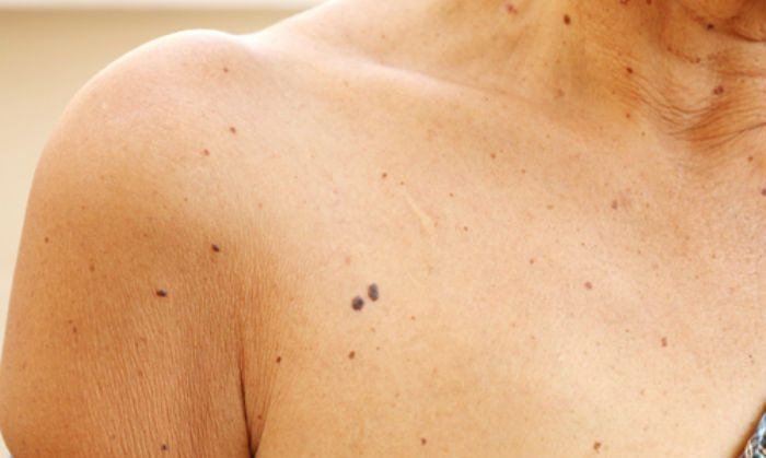 Women Chest with Slight Wrinkles what causes wrinkles, reverse aging, remove wrinkles, natural anti aging, wrinkle treatment