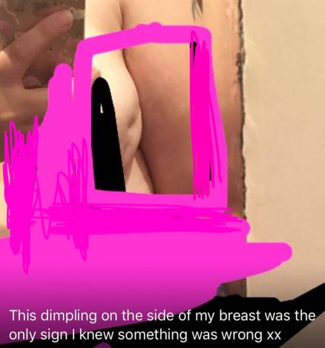 breast cancer signs, breast cancer awareness, cancer prevention