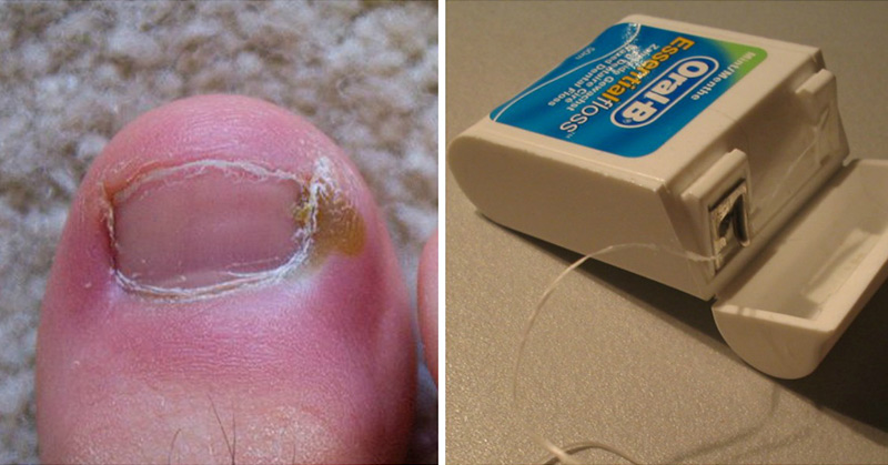 Ingrown Toenails: 6 Surprisingly Effective Home Remedies