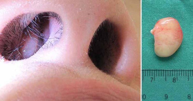 Nasal Polyps: Symptoms, Causes, and Treatments - Featured image