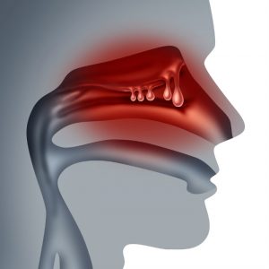 nasal polyps symptoms