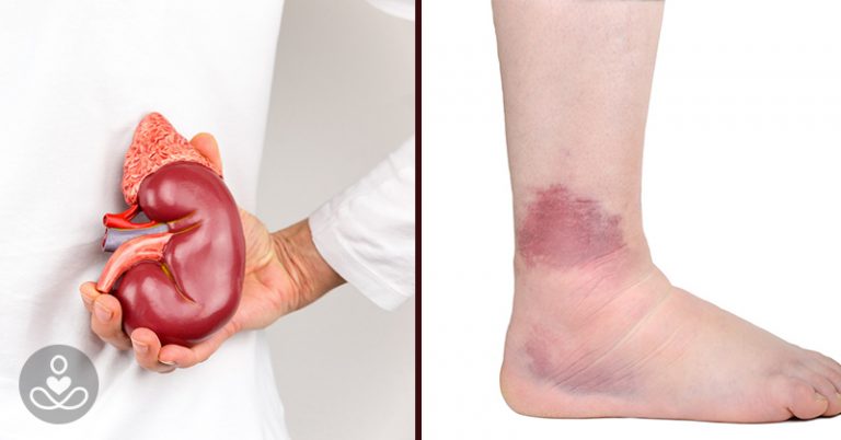 If Your Kidneys Are in Danger, Your Body Will Give You These 21 Signs - Featured image