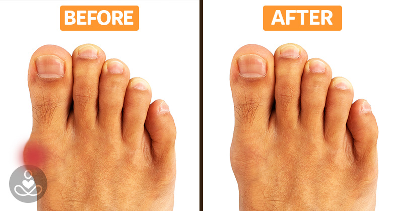 Don’t Let Bunions Control Your Life, Try This At-Home Bunion Treatment to Relieve Your Pain Today