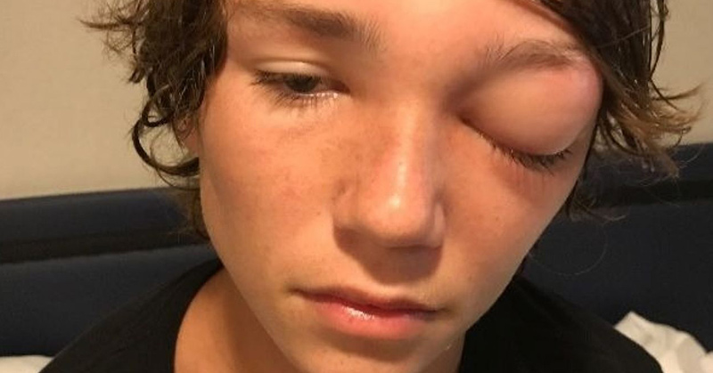 Orbital Cellulitis: How a Cruise Left a 15-Year-Old Blind in One Eye