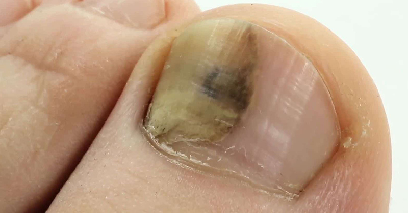 Nail Fungus: Symptoms, Treatment, and Home Remedies
