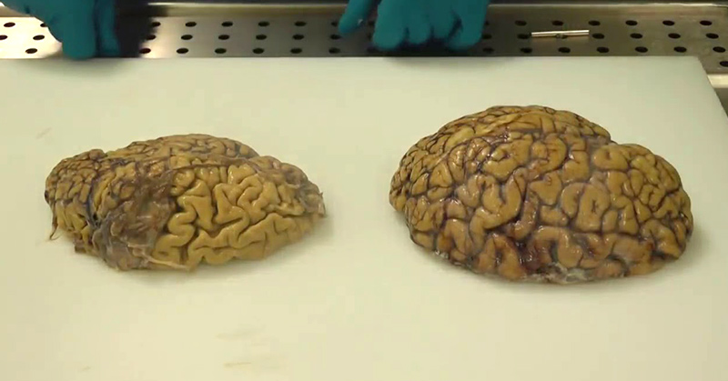 8 Steps to Help Prevent Alzheimer’s Disease