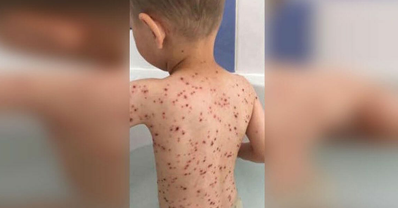 child with chickenpox