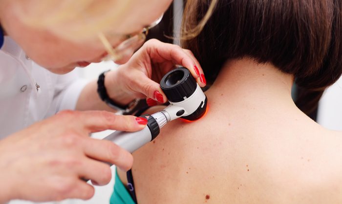 melanoma-check-up