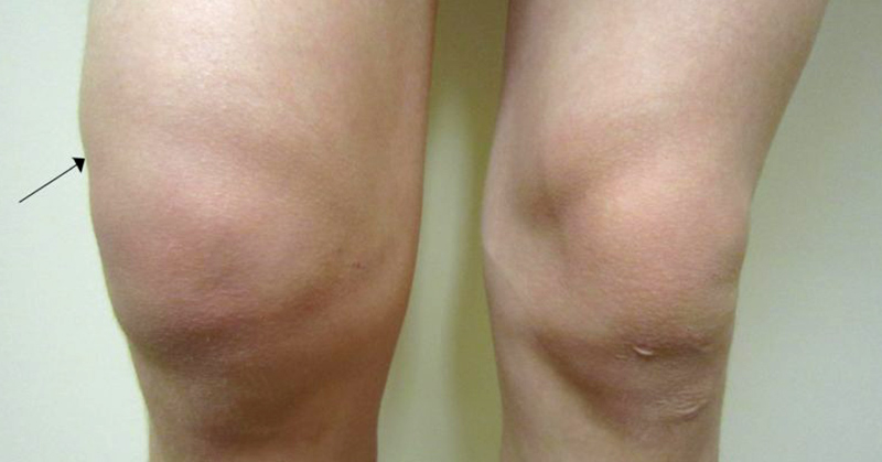 What is Fibromyalgia Swelling and What Causes it?