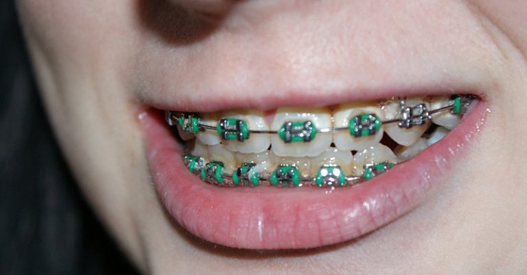 Endocarditis Linked to Metal from Braces of 15-Year-Old Leah Kitchen - Featured image