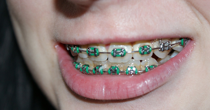Endocarditis Linked to Metal from Braces of 15-Year-Old Leah Kitchen