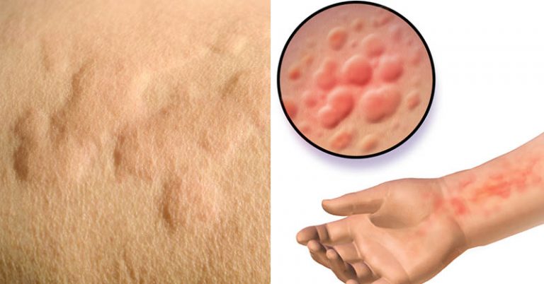 Cold Urticaria: Symptoms, Causes, and How to Treat Being Allergic to Cold - Featured image