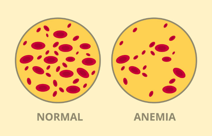Chemo Side Effect Anemia chemotherapy side effects