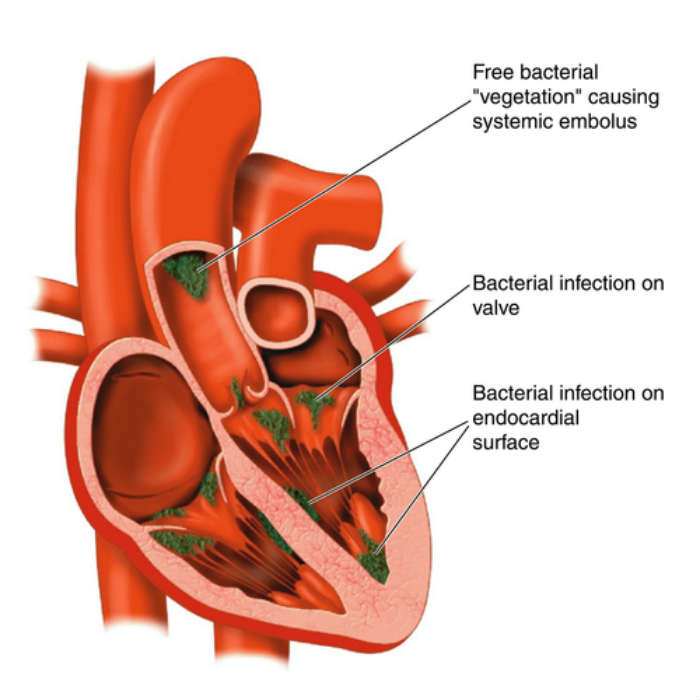 Endocarditis Diagram endocarditis symptoms